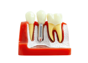 Burnos higiena prieš implantaciją