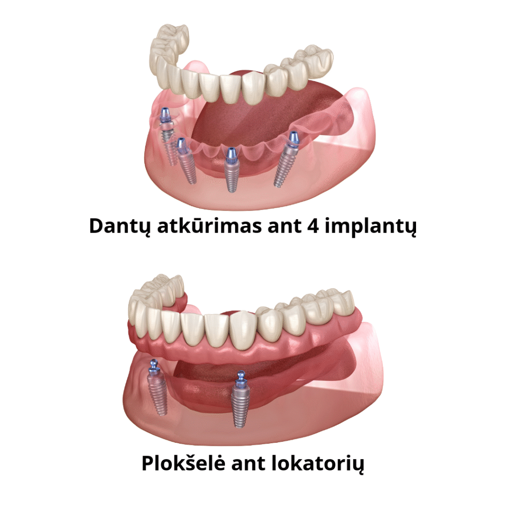 Dantų atkūrimas ant 4 implantų