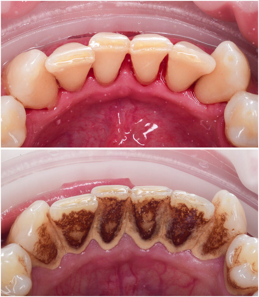 Burnos higiena prieš ir po