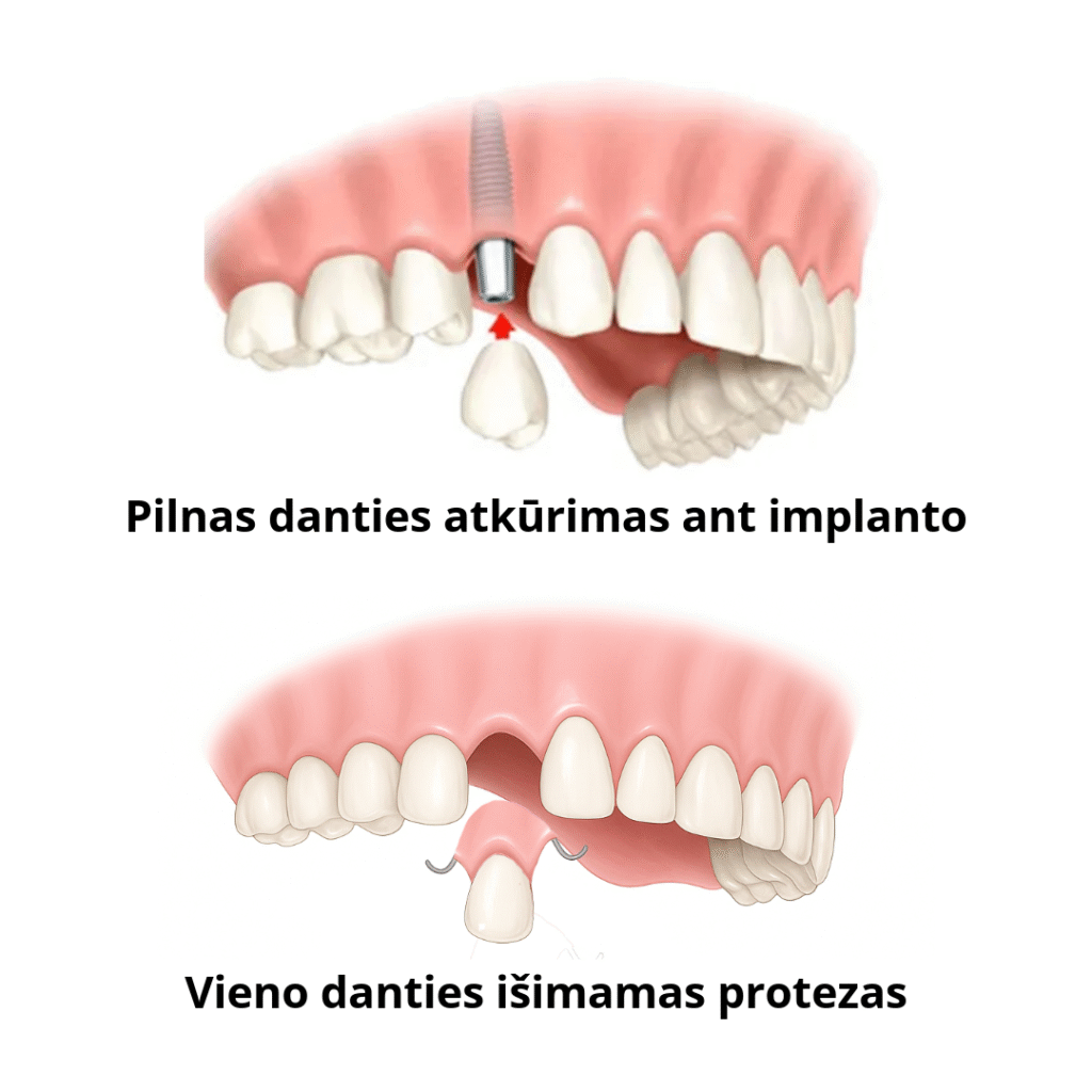 Pilnas danties atkūrtimas ant implanto