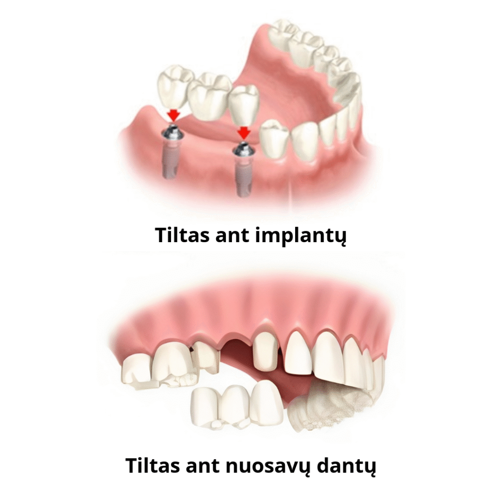 Tiltas ant implantų vs ant nuosavų dantų