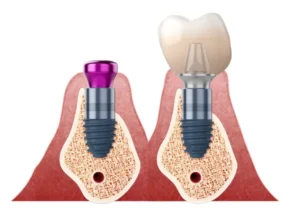 Danties implantacija - prigijimas
