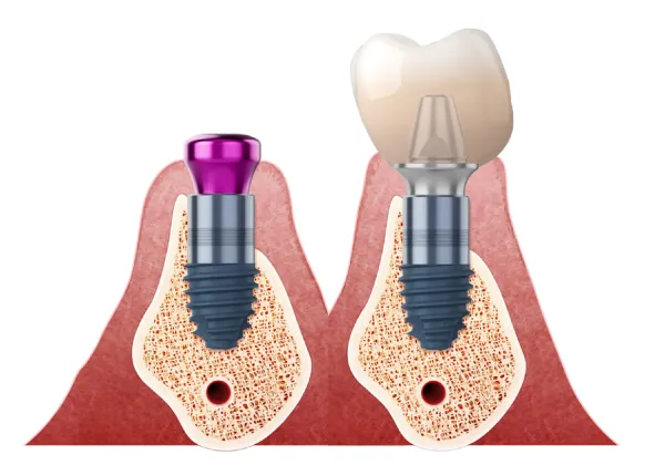 Danties implantacija - prigijimas